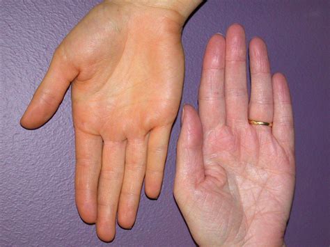 too much beta carotene|Carotenemia: Definition, Symptoms, Causes, and Treatment.